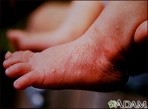 Erythema toxicum on the foot - Illustration Thumbnail                      