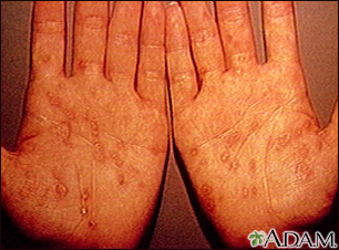 Syphilis - secondary on the palms - Illustration Thumbnail                      