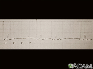 Atrioventricular block - ECG tracing - Illustration Thumbnail                      