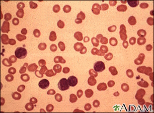 Chronic lymphocytic leukemia - microscopic view - Illustration Thumbnail                      