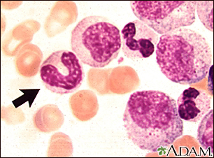 Chronic myelocytic leukemia - microscopic view - Illustration Thumbnail                      