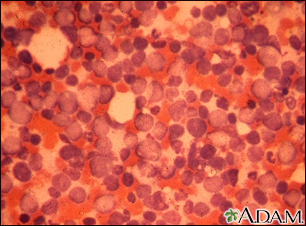 Chronic myelocytic leukemia - Illustration Thumbnail                      