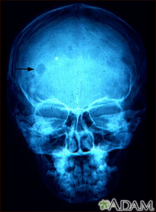 Eosinophilic granuloma - X-ray of the skull - Illustration Thumbnail                      