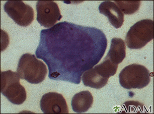 Mononucleosis - photomicrograph of cells - Illustration Thumbnail                      