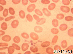Ovalocytoses - Illustration Thumbnail                      