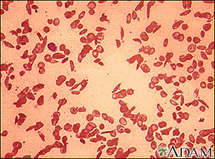 Red blood cells - sickle cells - Illustration Thumbnail                      