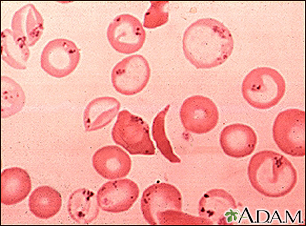 Red blood cells - sickle and Pappenheimer - Illustration Thumbnail                      