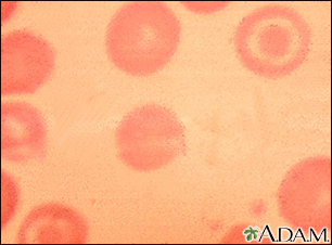 Red blood cells, target cells - Illustration Thumbnail                      