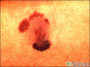 Skin cancer - malignant melanoma - Illustration Thumbnail                      