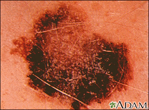 Skin cancer, melanoma - flat, brown lesion - Illustration Thumbnail                      