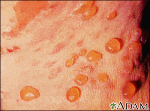 Bullous pemphigoid - close-up of tense blisters - Illustration Thumbnail                      