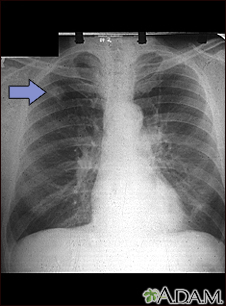 Adenocarcinoma - chest x-ray - Illustration Thumbnail                      