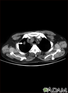 Pulmonary nodule, solitary - CT scan - Illustration Thumbnail                      