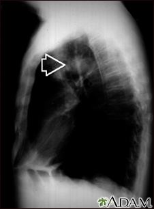 Pulmonary mass - side view chest X-ray - Illustration Thumbnail                      