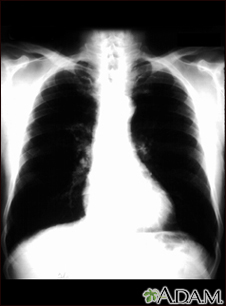 Bronchial cancer - chest X-ray - Illustration Thumbnail                      