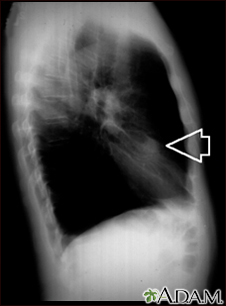 Lung nodule, right middle lobe - chest X-ray - Illustration Thumbnail                      