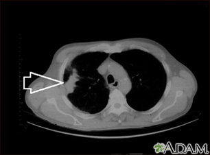 Lung mass, right lung - CT scan - Illustration Thumbnail                      