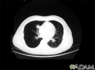 Lung nodule, right lower lung - CT scan - Illustration Thumbnail                      