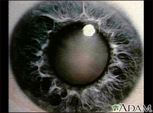 Cataract - close-up of the eye