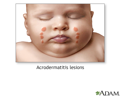 Acrodermatitis - Illustration Thumbnail                      