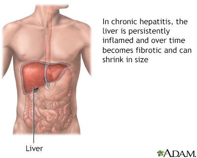Chronic hepatitis - Illustration Thumbnail                      