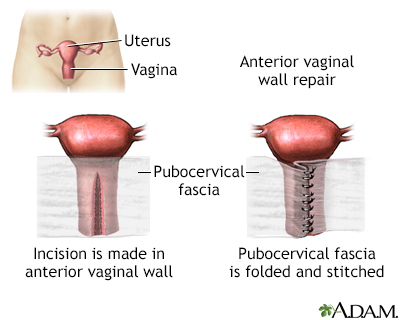 Anterior vaginal wall repair - Illustration Thumbnail                      