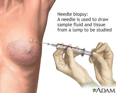 Needle biopsy of the breast - Illustration Thumbnail                      