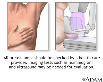 Breast lumps - Illustration Thumbnail                      