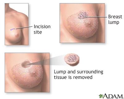 Lumpectomy - Illustration Thumbnail                      
