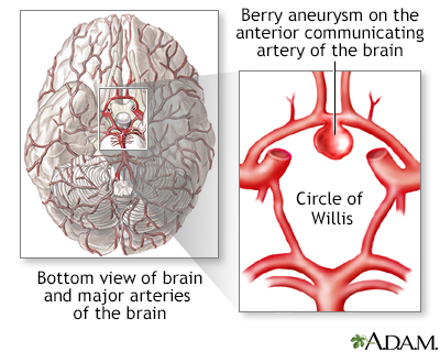 Cerebral aneurysm - Illustration Thumbnail                      