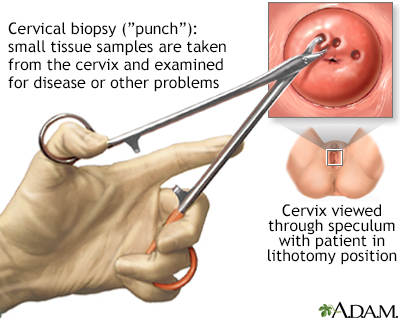 Cervical biopsy - Illustration Thumbnail                      