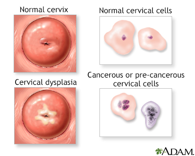 Cervical neoplasia - Illustration Thumbnail                      
