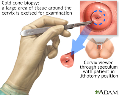 Cold cone biopsy - Illustration Thumbnail                      