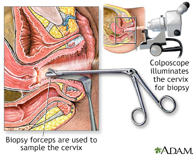 Colposcopy-directed biopsy - Illustration Thumbnail                      