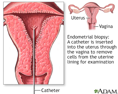 Endometrial biopsy - Illustration Thumbnail                      