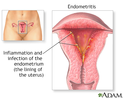 Endometritis - Illustration Thumbnail                      