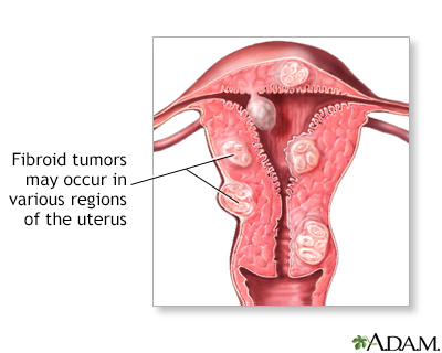 Fibroid tumors - Illustration Thumbnail                      