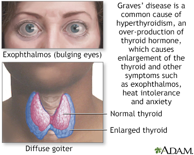 Graves disease - Illustration Thumbnail                      