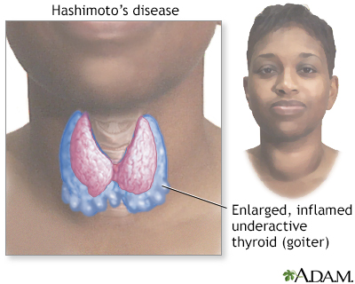 Hashimoto's disease (chronic thyroiditis) - Illustration Thumbnail                      
