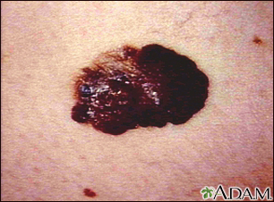 Skin cancer, melanoma - raised, dark lesion - Illustration Thumbnail                      