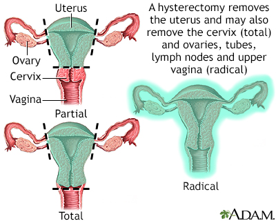 Hysterectomy - Illustration Thumbnail                      