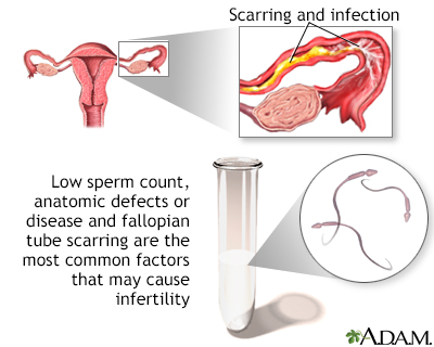 Primary infertility - Illustration Thumbnail                      