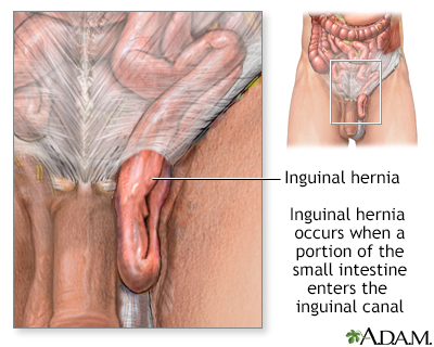 Inguinal hernia - Illustration Thumbnail                      