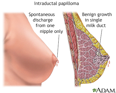 Intraductal papilloma - Illustration Thumbnail                      