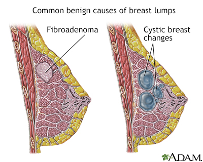 Causes of breast lumps - Illustration Thumbnail                      