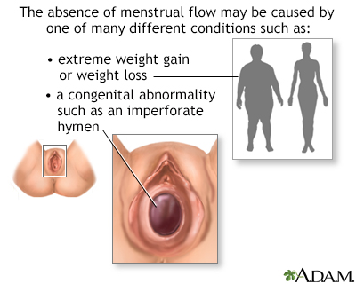 Absence of menstruation (amenorrhea) - Illustration Thumbnail                      
