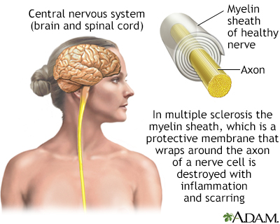 Multiple sclerosis - Illustration Thumbnail                      
