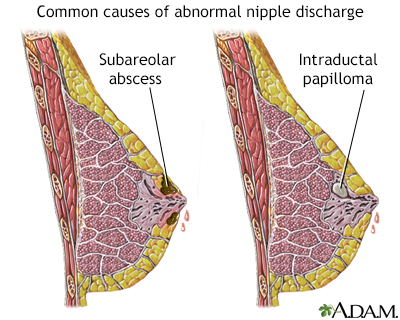 Abnormal discharge from the nipple - Illustration Thumbnail                      