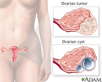 Ovarian growth worries - Illustration Thumbnail                      