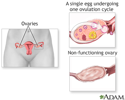 Ovarian hypofunction - Illustration Thumbnail                      